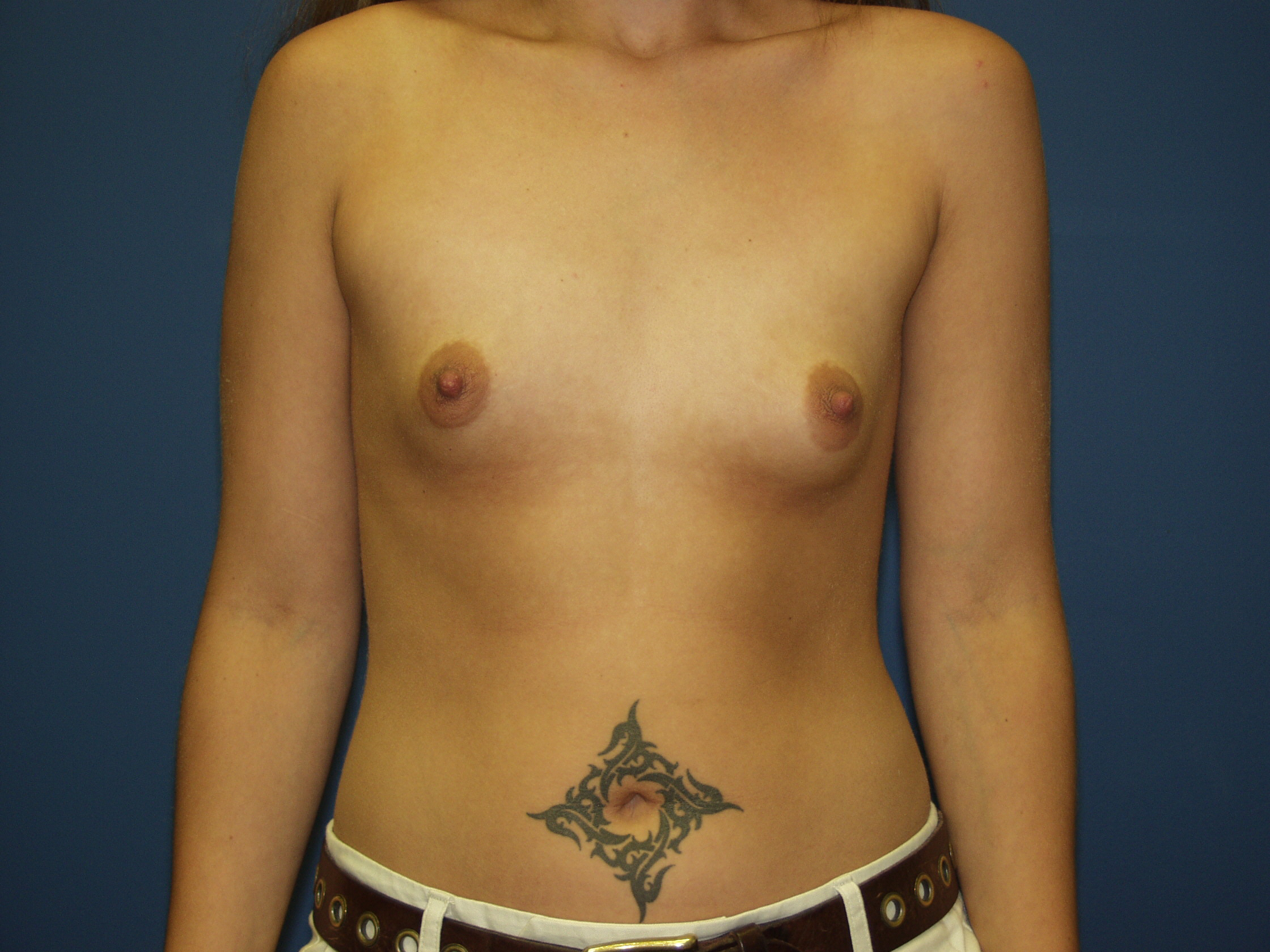 Breast Augmentation Before & After Patient #1544