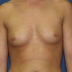 Breast Augmentation Before & After Patient #2780