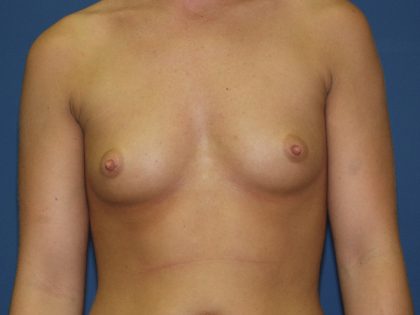 Breast Augmentation Before & After Patient #2780