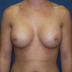 Breast Augmentation Before & After Patient #2780