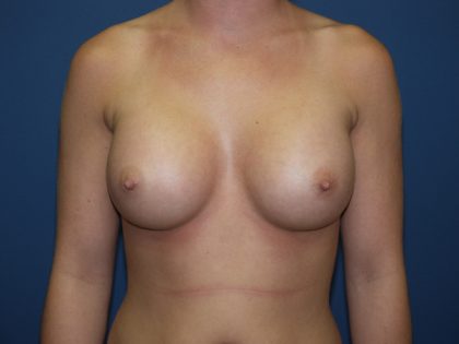 Breast Augmentation Before & After Patient #2780