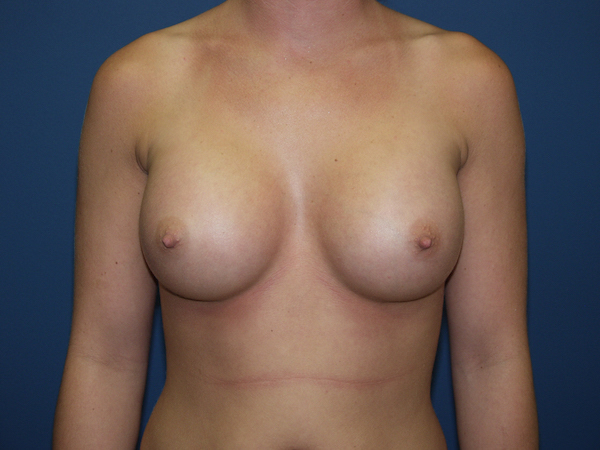 Breast Augmentation Before & After Patient #2780