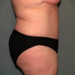 Tummy Tuck Before & After Patient #2323