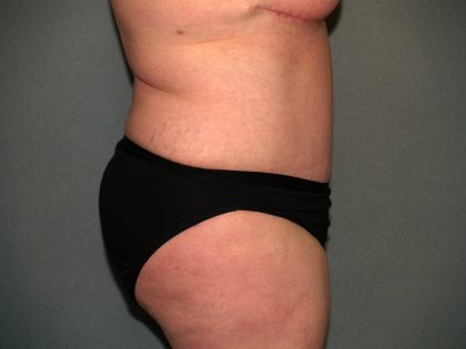 Tummy Tuck Before & After Patient #2323