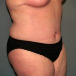 Tummy Tuck Before & After Patient #2323