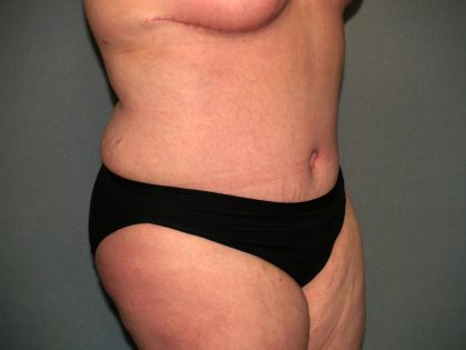 Tummy Tuck Before & After Patient #2323