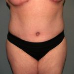 Tummy Tuck Before & After Patient #2323