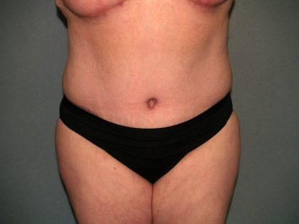 Tummy Tuck Before & After Patient #2323