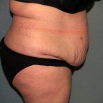 Tummy Tuck Before & After Patient #2323