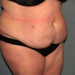 Tummy Tuck Before & After Patient #2323