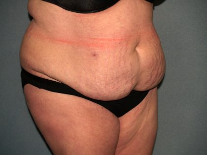 Tummy Tuck Before & After Patient #2323