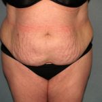 Tummy Tuck Before & After Patient #2323