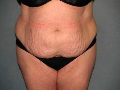 Tummy Tuck Before & After Patient #2323