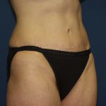 Tummy Tuck Before & After Patient #2082