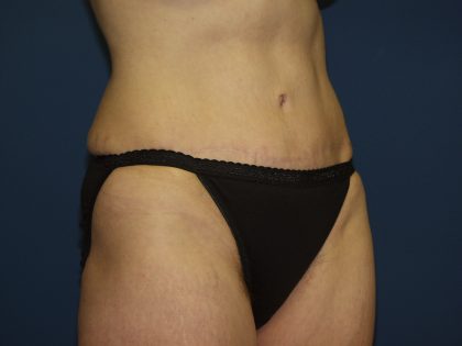 Tummy Tuck Before & After Patient #2082