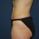 Tummy Tuck Before & After Patient #2082