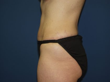 Tummy Tuck Before & After Patient #2082