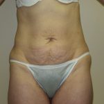 Tummy Tuck Before & After Patient #2082