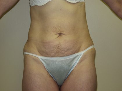 Tummy Tuck Before & After Patient #2082