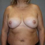 Breast Reconstruction Before & After Patient #1933