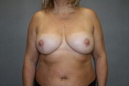 Breast Reconstruction Before & After Patient #1933