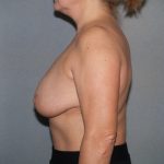 Breast Reconstruction Before & After Patient #1933