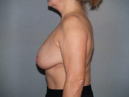 Breast Reconstruction Before & After Patient #1933