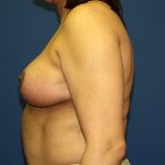 Breast Reduction Before & After Patient #3383