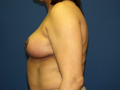 Breast Reduction Before & After Patient #3383