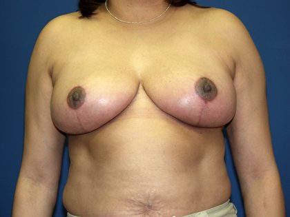 Breast Reduction Before & After Patient #3383