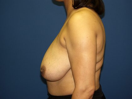 Breast Reduction Before & After Patient #3383