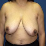 Breast Reduction Before & After Patient #3383
