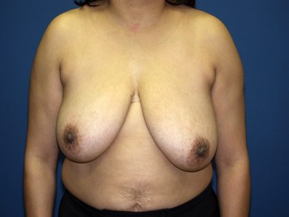 Breast Reduction Before & After Patient #3383