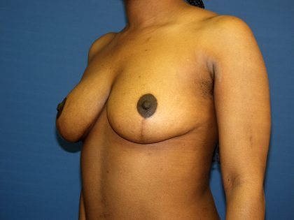 Breast Reduction Before & After Patient #3315