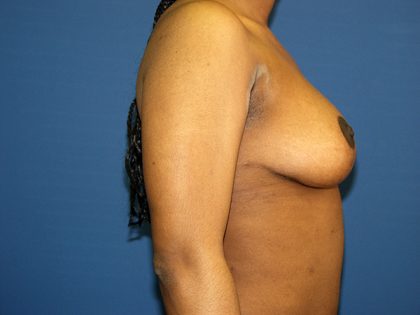 Breast Reduction Before & After Patient #3315