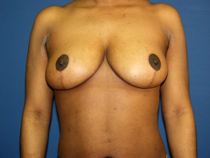 Breast Reduction Before & After Patient #3315