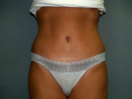 Tummy Tuck Before & After Patient #2176