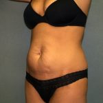 Tummy Tuck Before & After Patient #2176