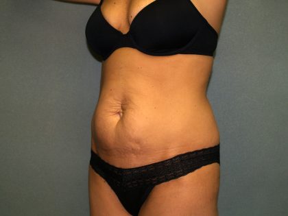 Tummy Tuck Before & After Patient #2176