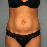 Tummy Tuck Before & After Patient #2176