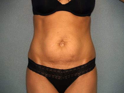 Tummy Tuck Before & After Patient #2176