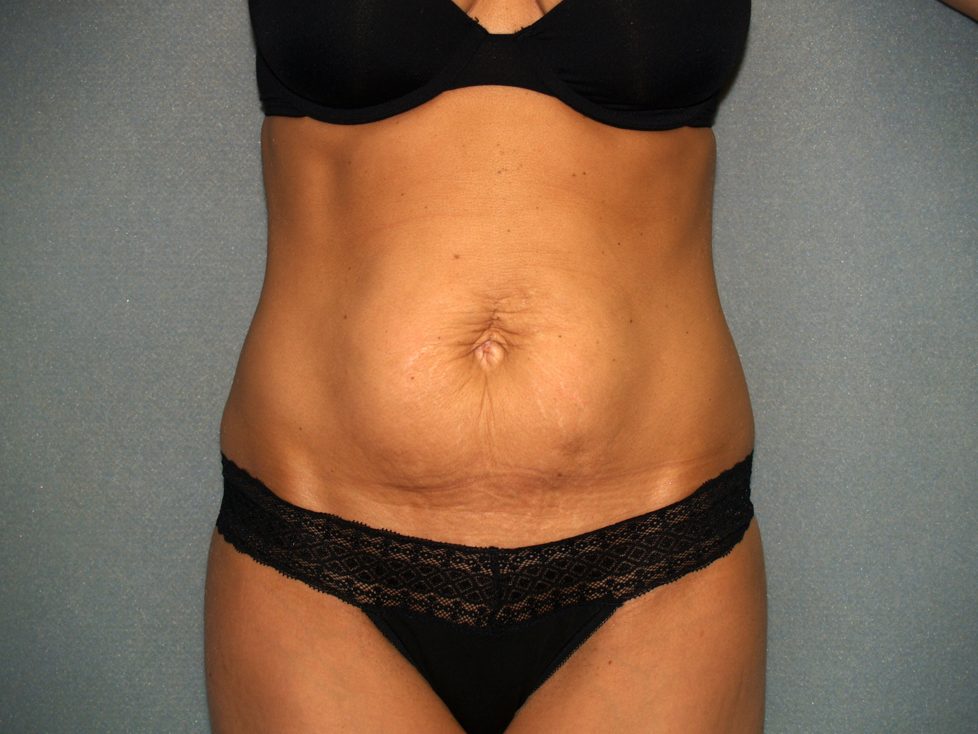 Tummy Tuck Before & After Patient #2176