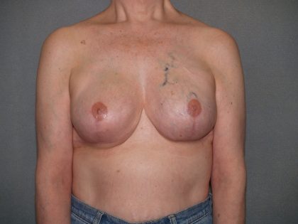 Breast Reconstruction Before & After Patient #1991