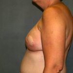 Breast Reconstruction Before & After Patient #2259