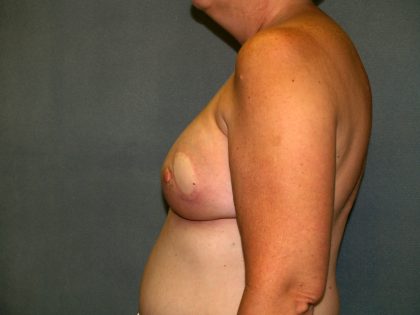 Breast Reconstruction Before & After Patient #2259