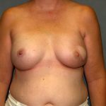 Breast Reconstruction Before & After Patient #2259