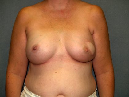 Breast Reconstruction Before & After Patient #2259