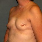 Breast Reconstruction Before & After Patient #2259