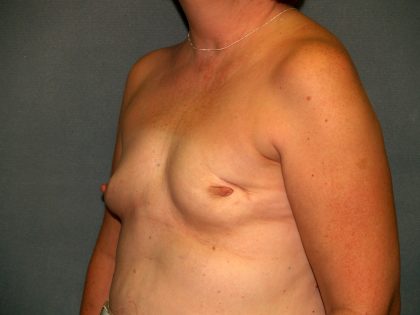 Breast Reconstruction Before & After Patient #2259