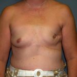 Breast Reconstruction Before & After Patient #2259